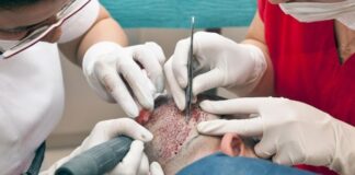 השתלת שיער לנשים: הפתרון המושלם