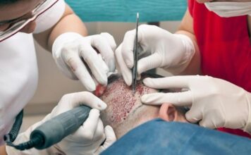 השתלת שיער לנשים: הפתרון המושלם