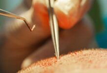 השתלת שיער בישראל: כל מה שצריך לדעת