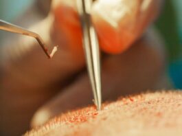 השתלת שיער בישראל: כל מה שצריך לדעת