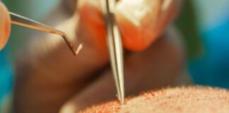 השתלת שיער בישראל: כל מה שצריך לדעת